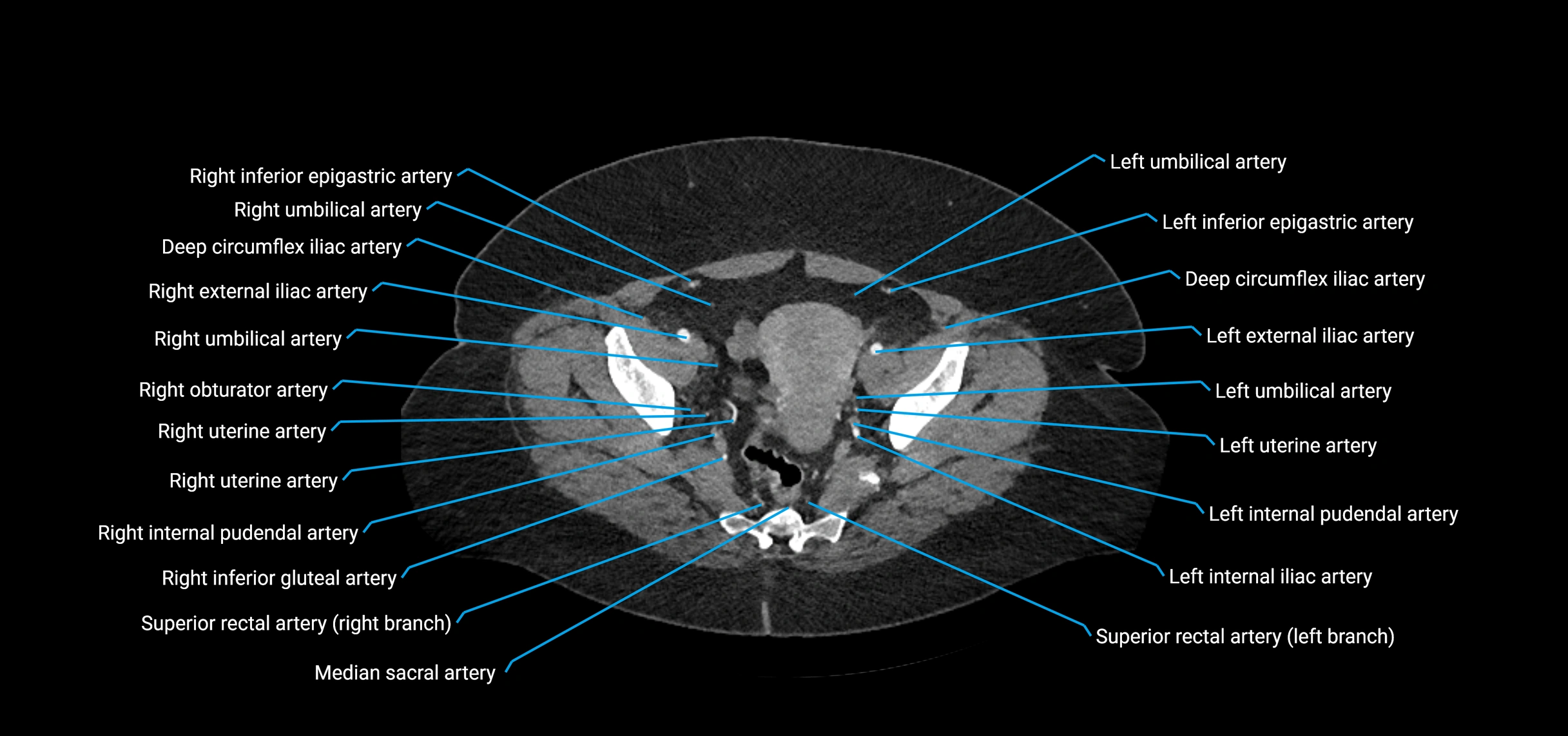 CTA abdomen axial cross sectional anatomy labelled image_217 (2).webp